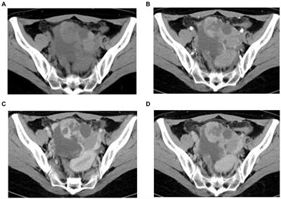 Struma ovarii with Hashimoto’s thyroiditis: case report and review of the literature